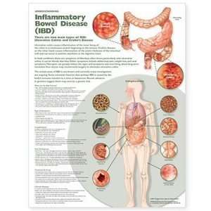  Inflammatory Bowel Disease (IBD) Chart/Poster: Health 
