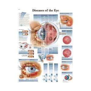 Diseases of the Eye   Anatomical Chart:  Industrial 
