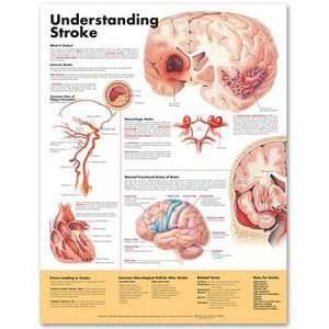 Understanding Stroke Anatomical Chart/Poster  Industrial 